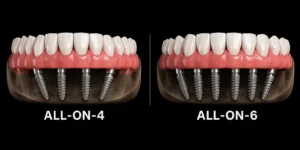 All-on-4 ve All-on-6 tedavisinde dört ve altı implant yerleşiminin karşılaştırılması